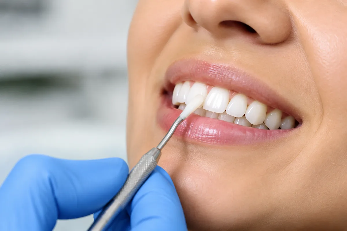 Cosmetic bonding